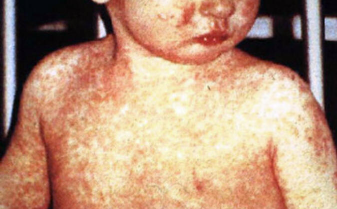 বরিশালে হামে আক্রান্ত হয়ে ৮ শিশুর মৃত্যু